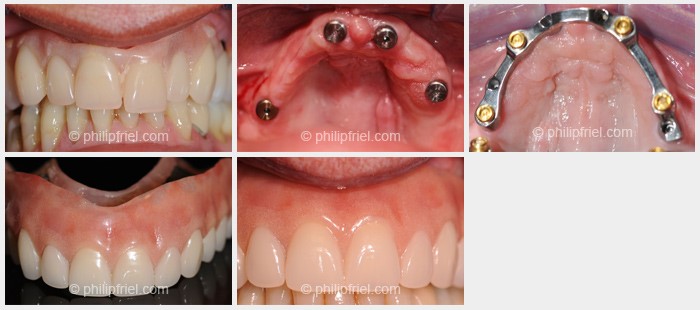 Mouth Care With Dentures Eliot ME 3903